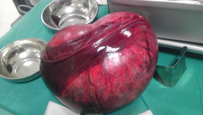 Karnından 5 kilo kitle çıkarıldı